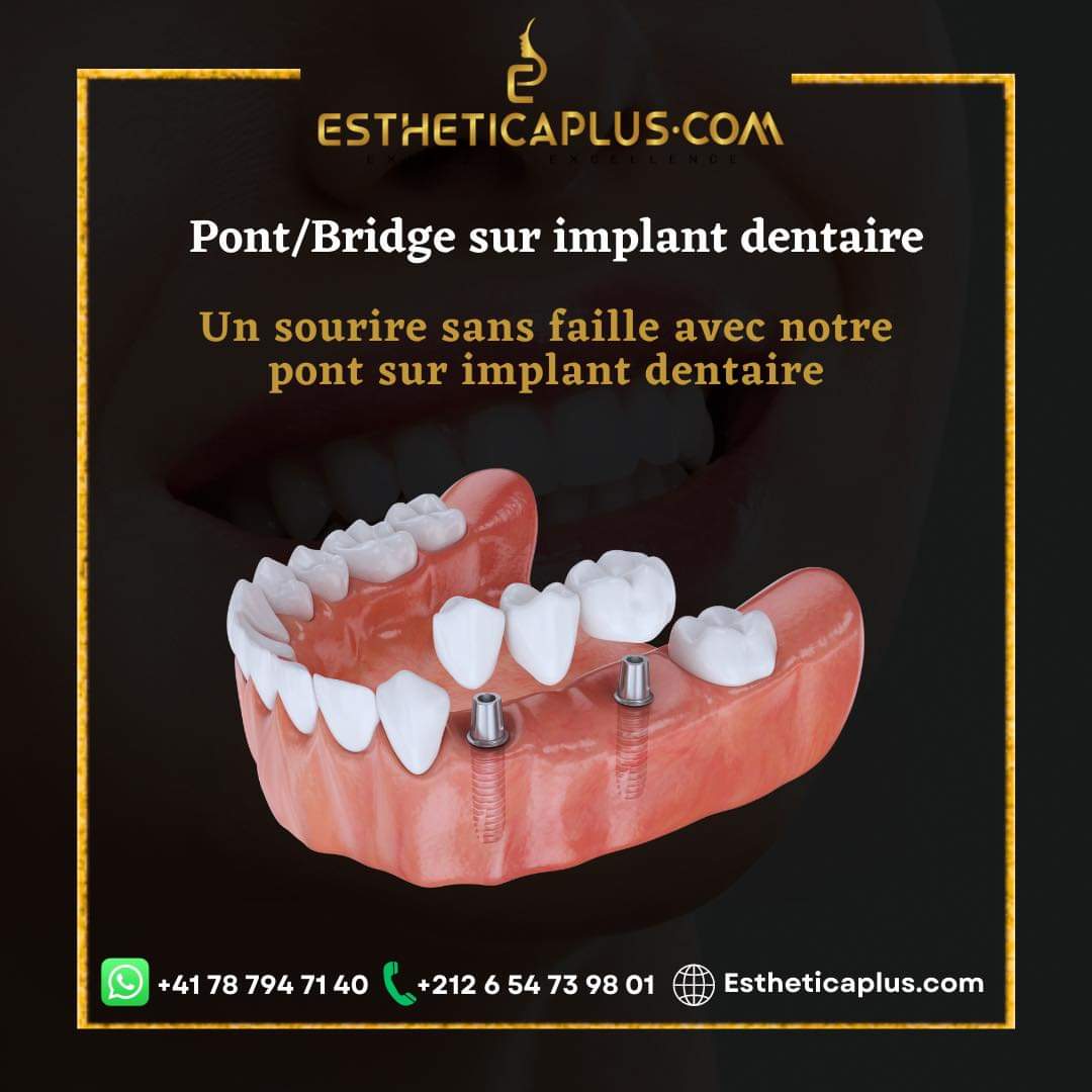 pont bridge sur implant