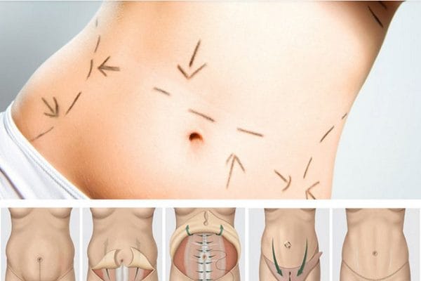 abdominoplastie im