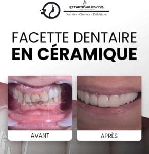 Facette dentaire au Maroc
