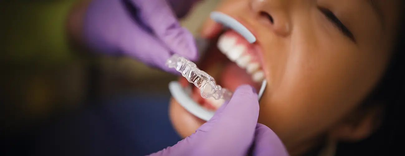invisalign au Maroc