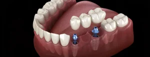 Tout ce que vous devez savoir d’un pont et bridge sur implant