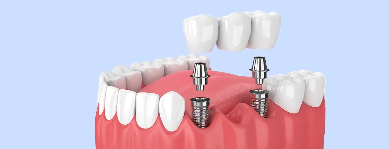 pont et bridge sur implant