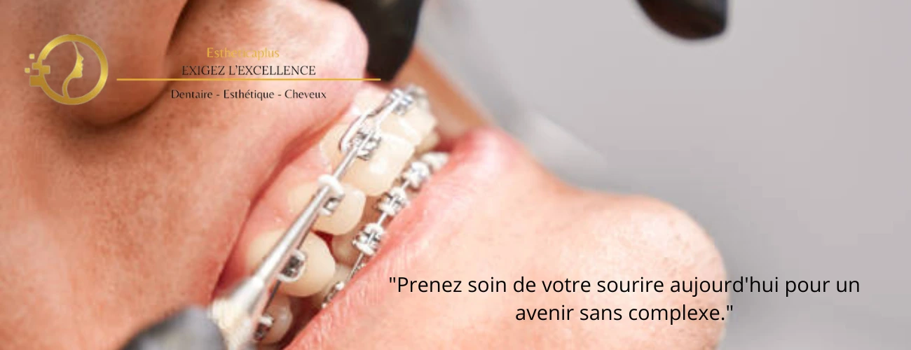 Chez EstheticaPlus, l'orthodontie devient accessible, efficace et adaptée à tous les âges. Durabilité, esthétique et confort au meilleur prix 