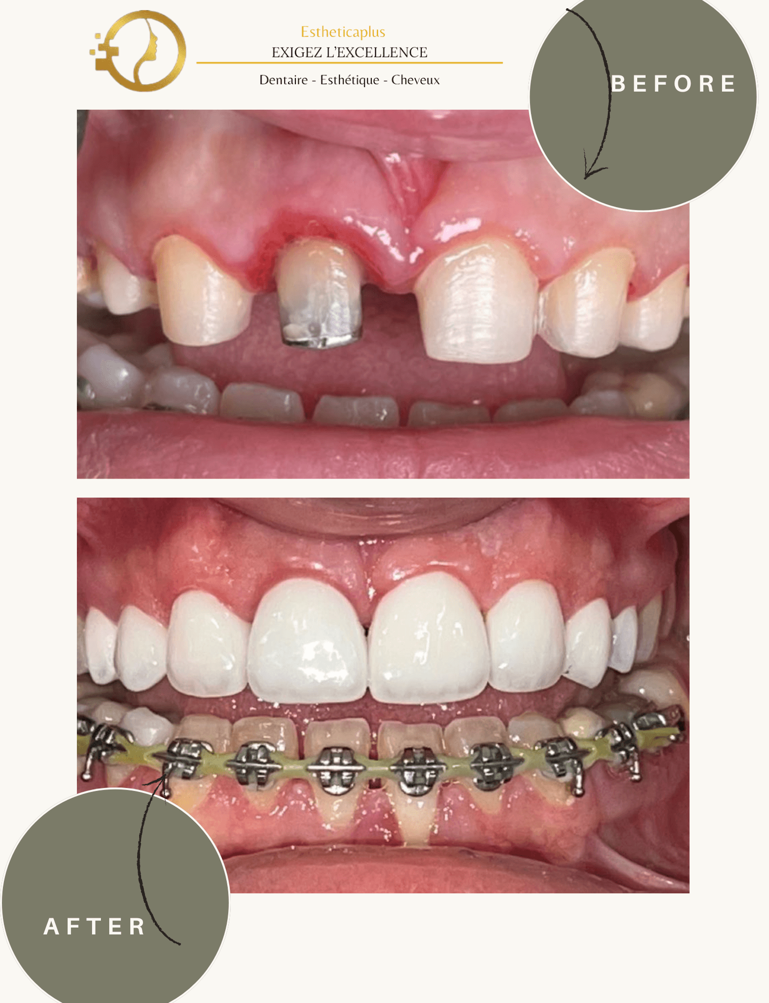 Résultat esthétique dentaire EstheticaPlus