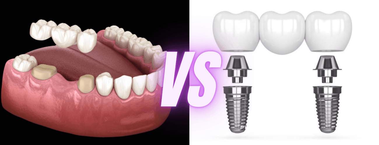 implant dentaire vs bridge