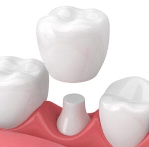 dental crowns 407x400 1