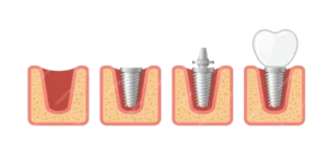 dental implant human teeth set vector 273456 58 removebg preview