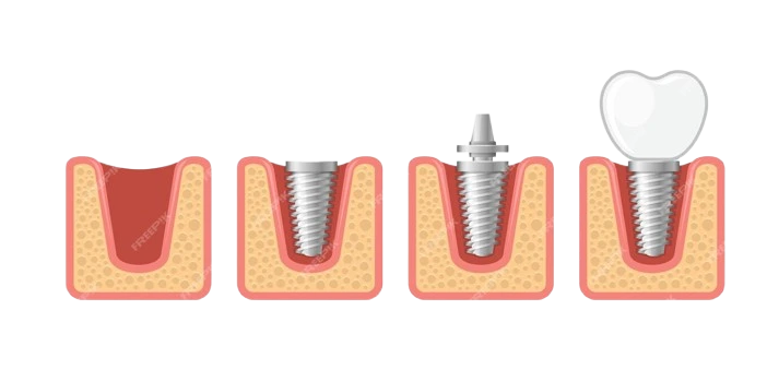 dental implant human teeth set vector 273456 58 removebg preview