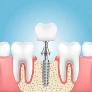 human jaw with health teeth prosthesis with implant crown 53500 174