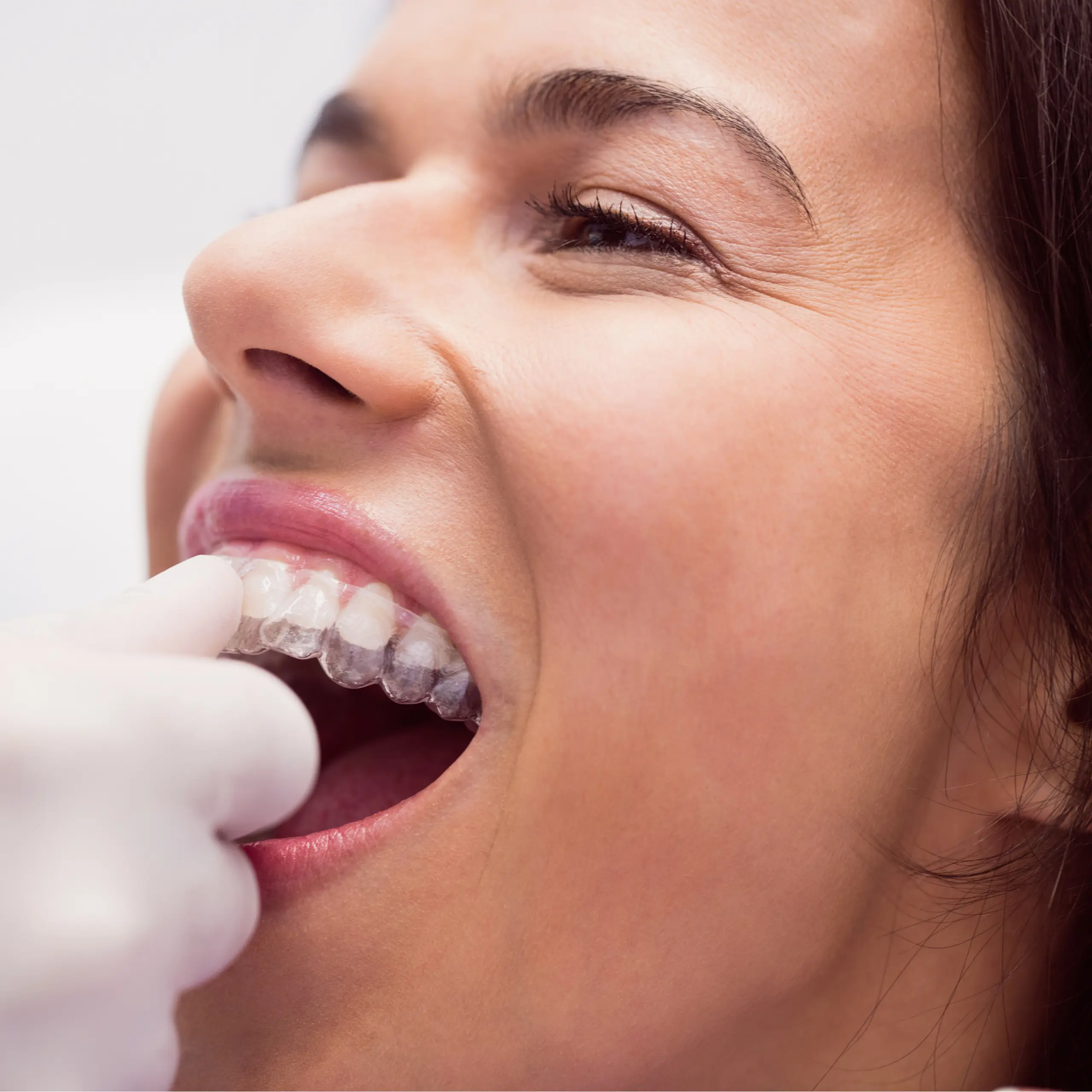 Traitement Invisalign au Maroc pour aligner les dents en toute discrétion