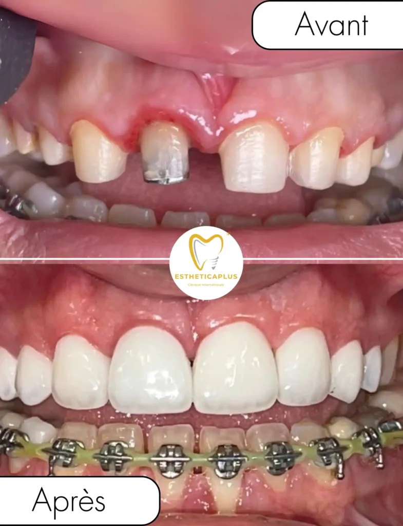 implant dentaire maroc