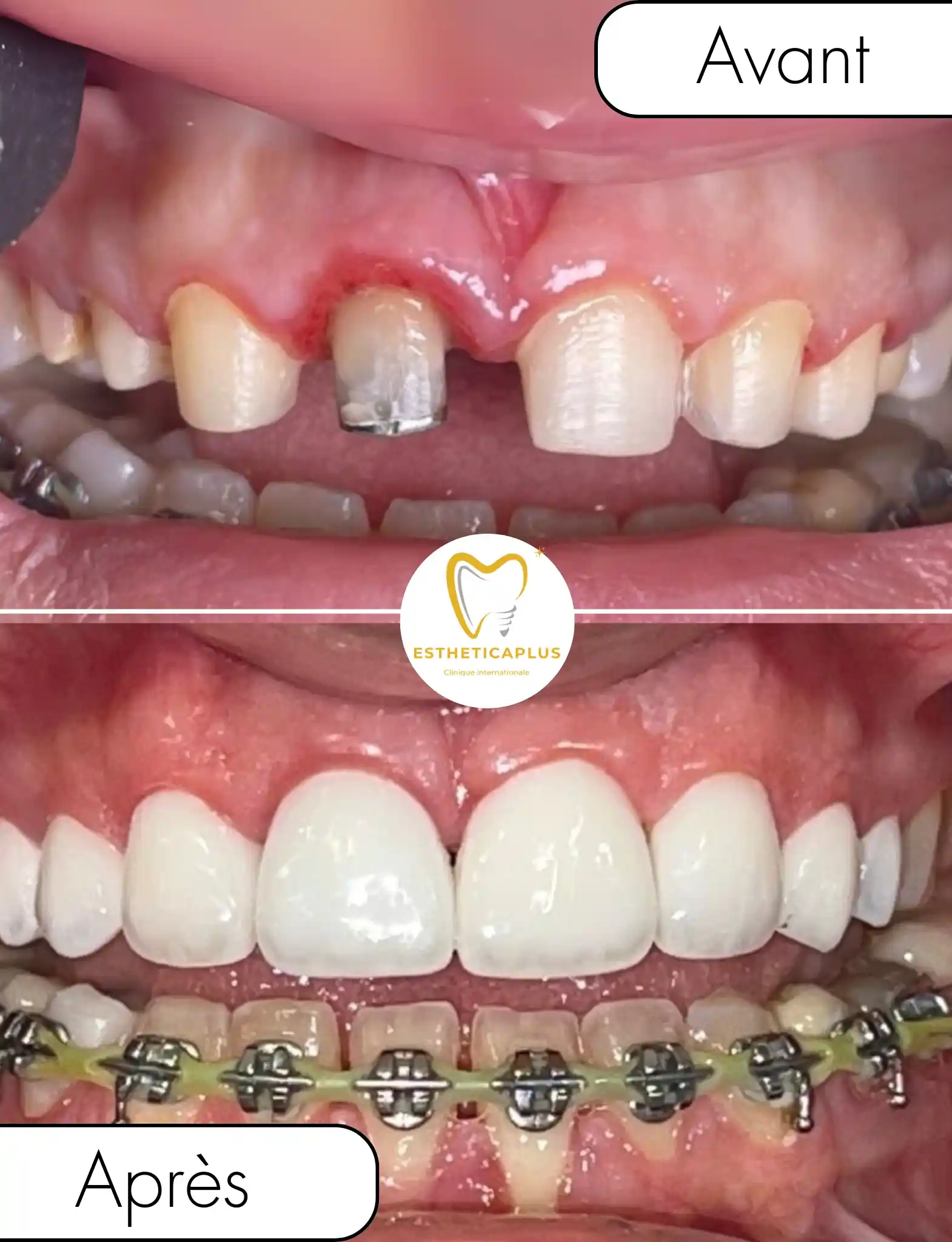 Before and after 1 dental crown and 7 veneers Hollywood smile EstheticaPlus Tanger