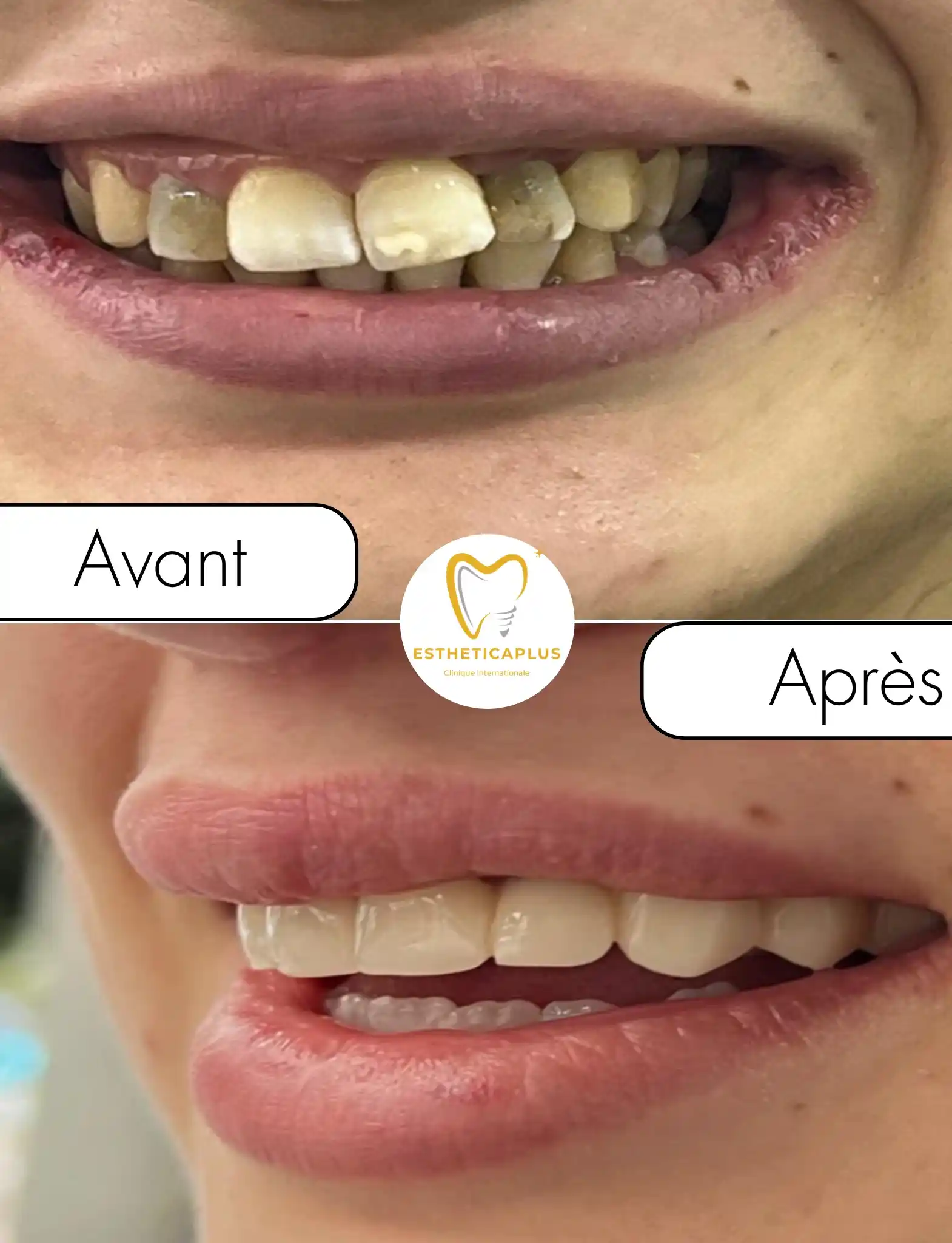 Before and after dental bridge and crowns EstheticaPlus Tanger Morocco