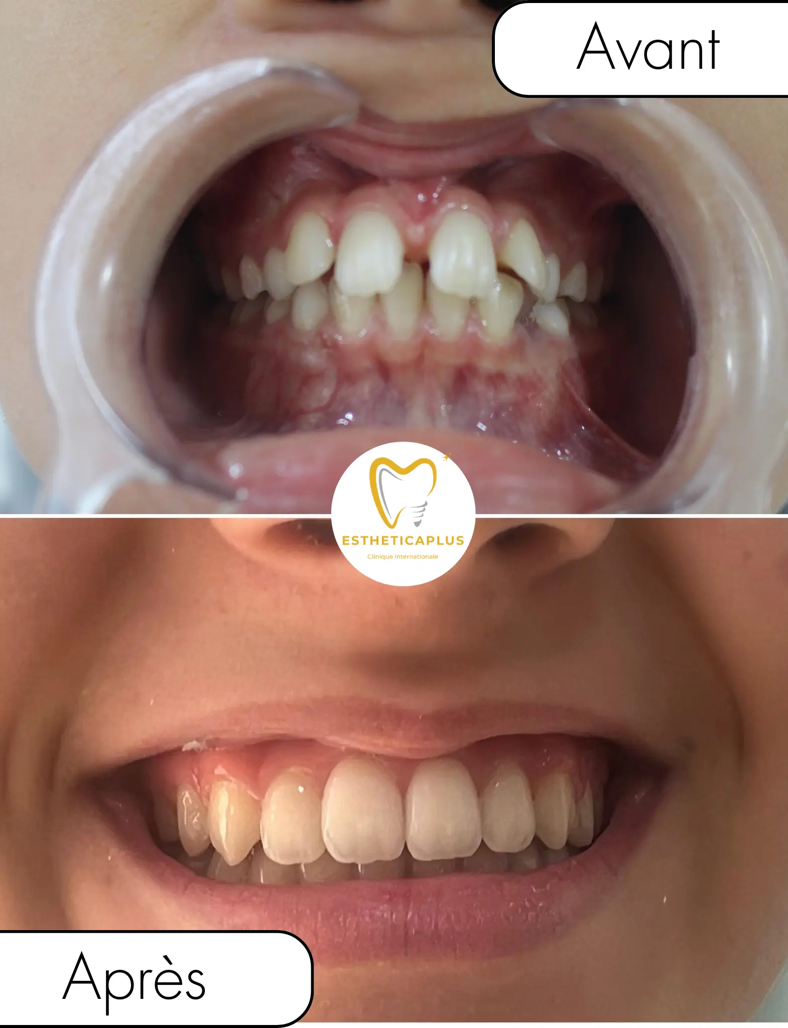 Before and after orthodontic treatment clear aligners EstheticaPlus Tanger Morocco