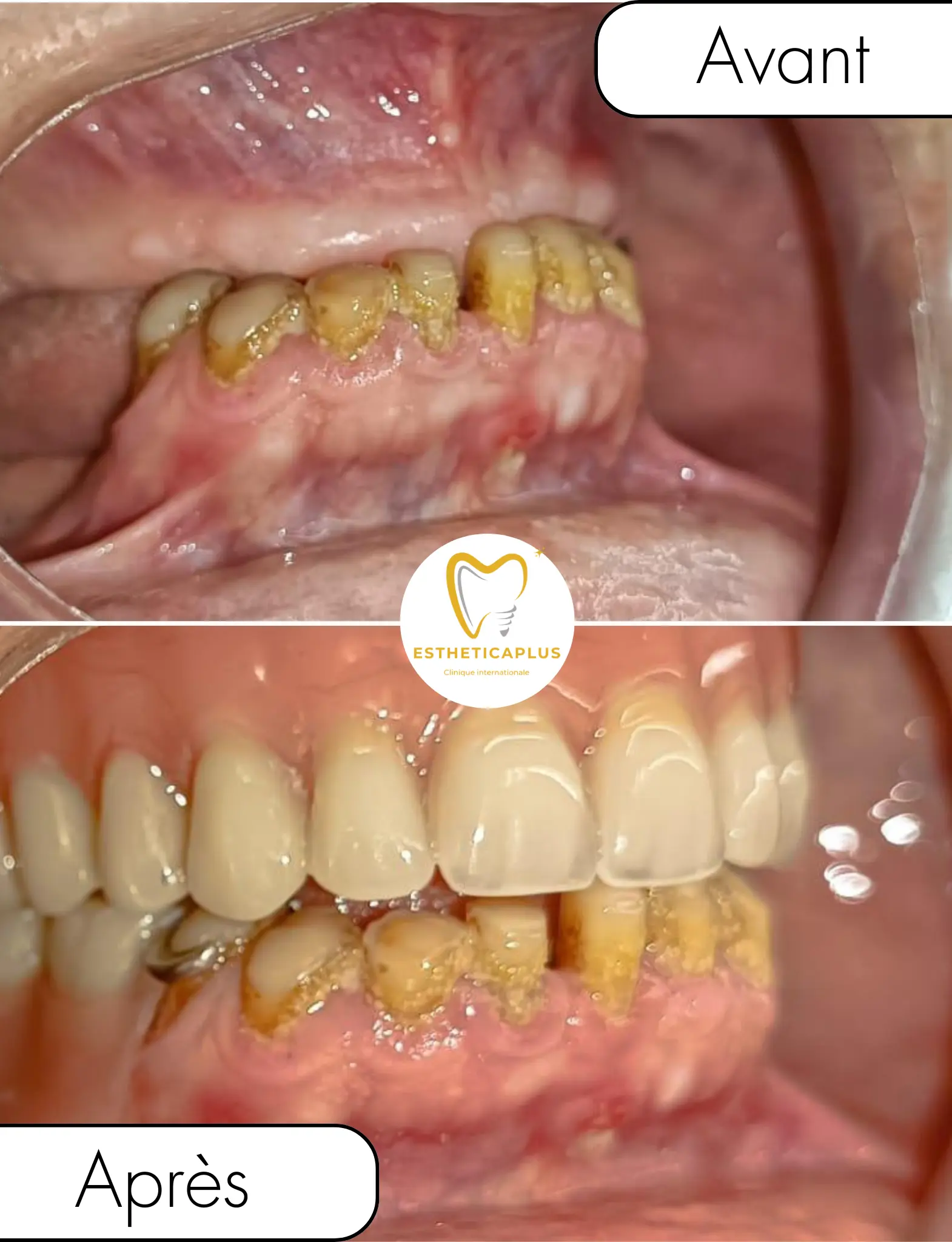 Before and after removable dental denture EstheticaPlus Tanger Morocco