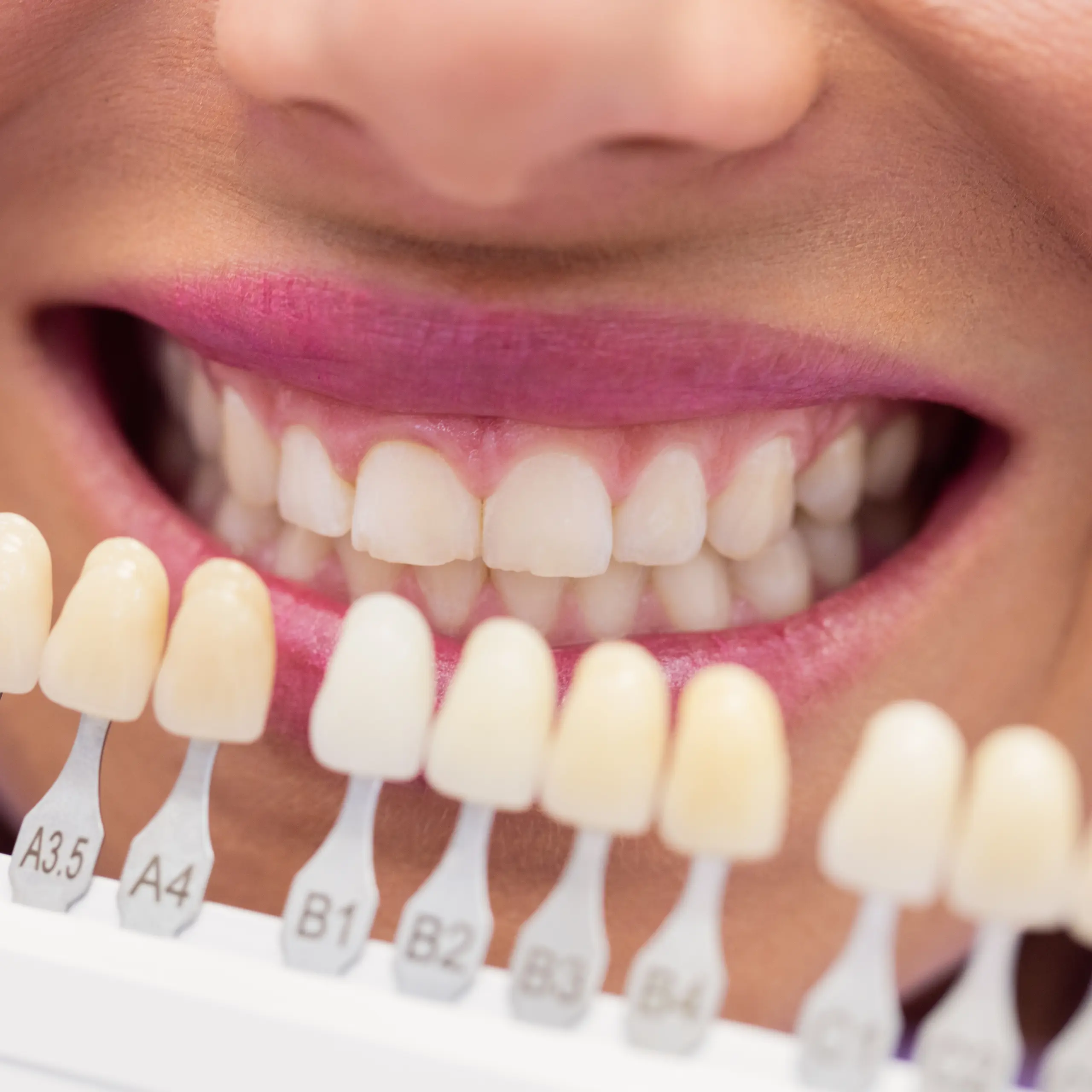 Couronne dentaire au Maroc pour restaurer une dent abîmée