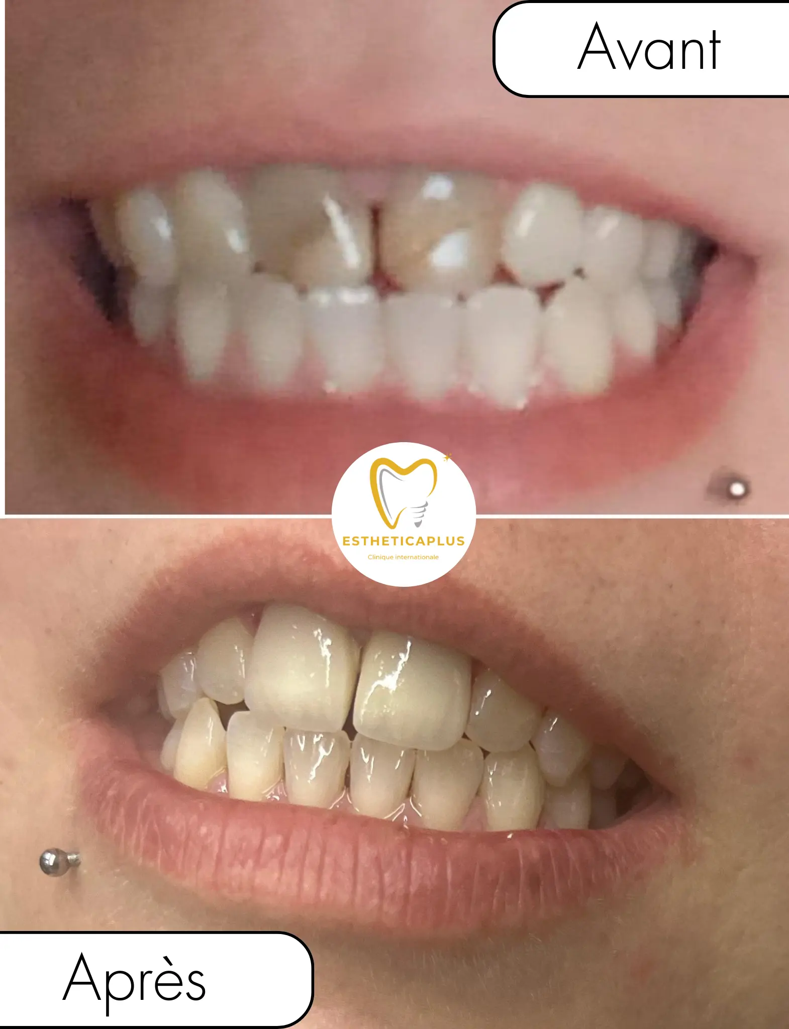 Before and after dental crowns EstheticaPlus Tanger Morocco