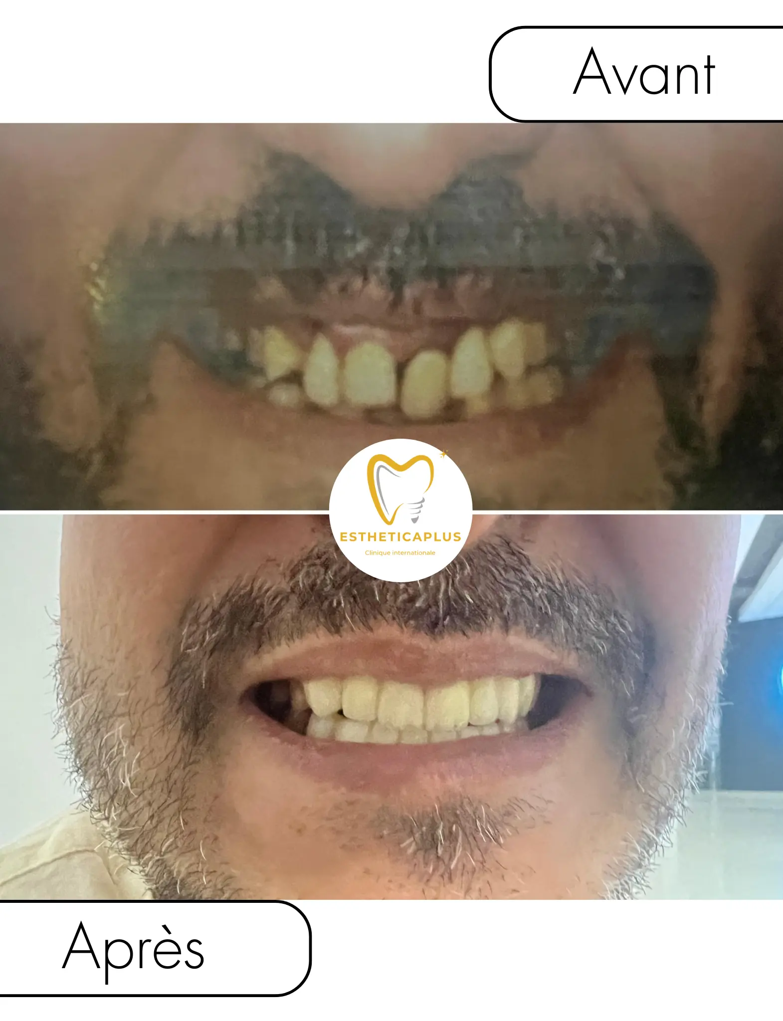 Before and after dental implants EstheticaPlus Tanger Morocco results