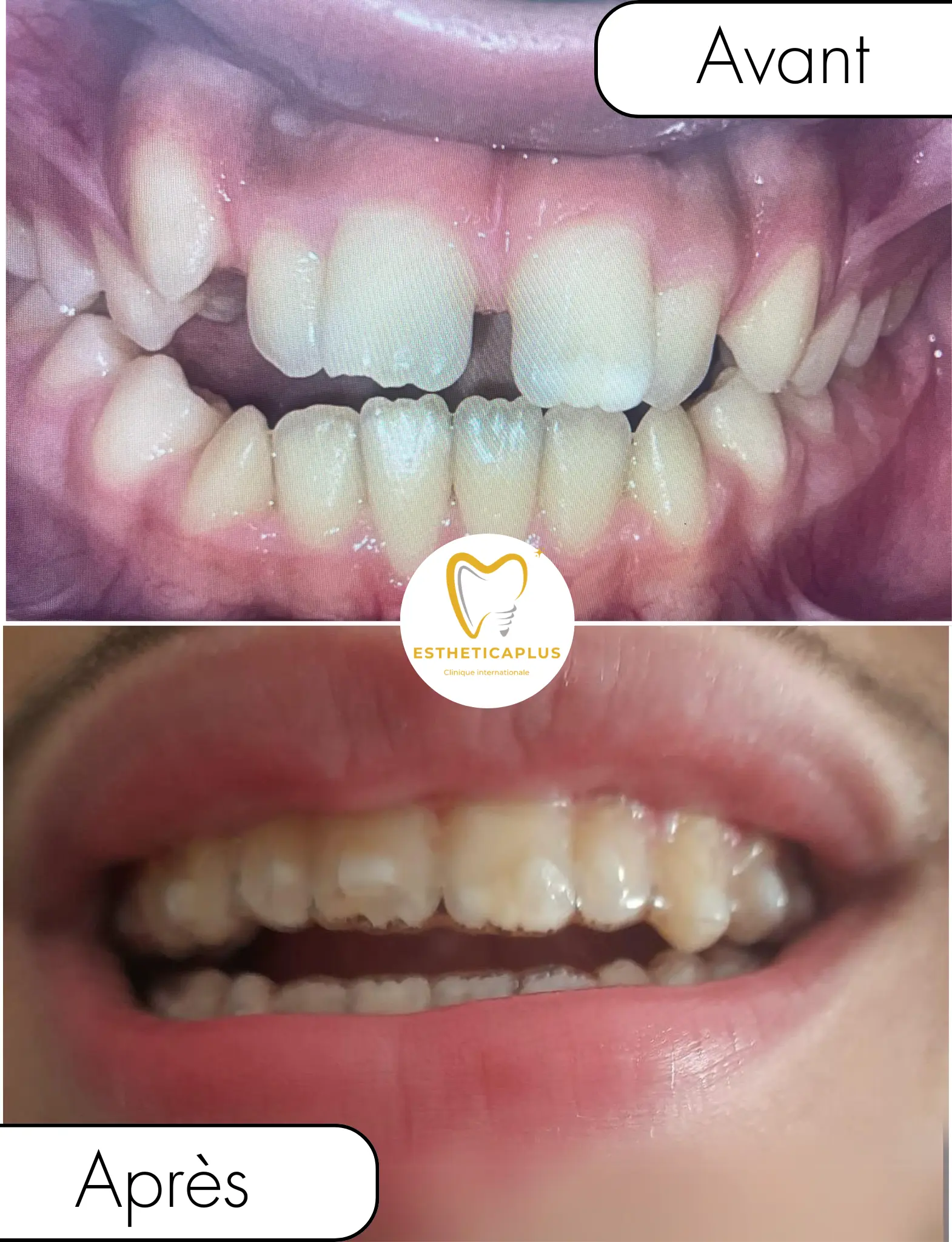 Before and after Invisalign clear aligners orthodontics EstheticaPlus Tanger Morocco