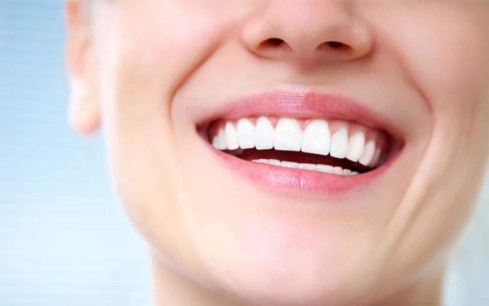 Facettes dentaires au Maroc pour un sourire hollywoodien