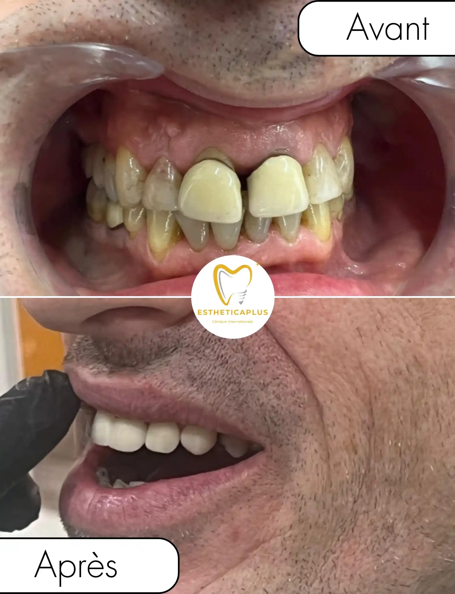Before and after 5 crowns and 4 dental implants Tanger Morocco EstheticaPlus