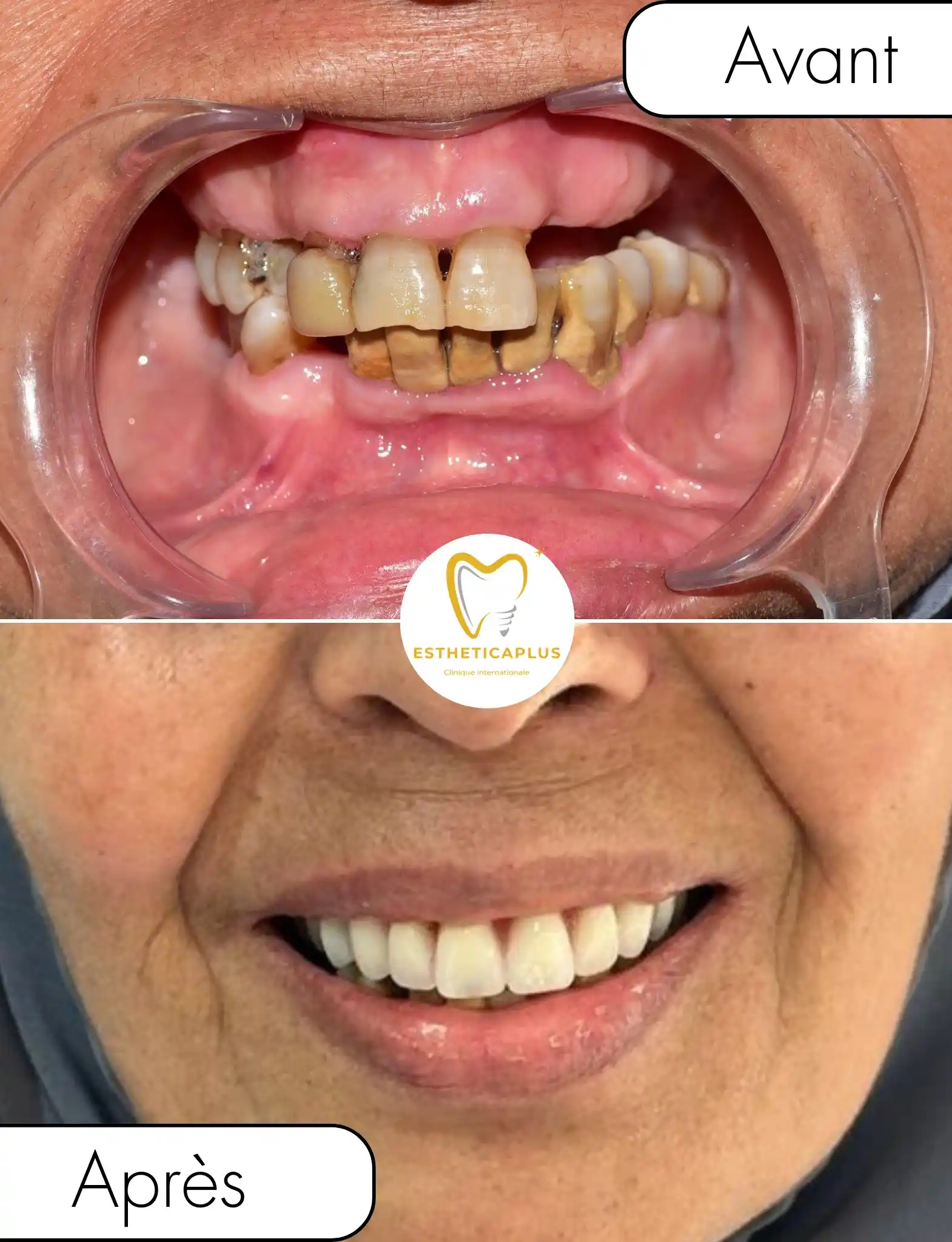 Before and after All-on-6 dental implants full arch reconstruction Tanger Morocco