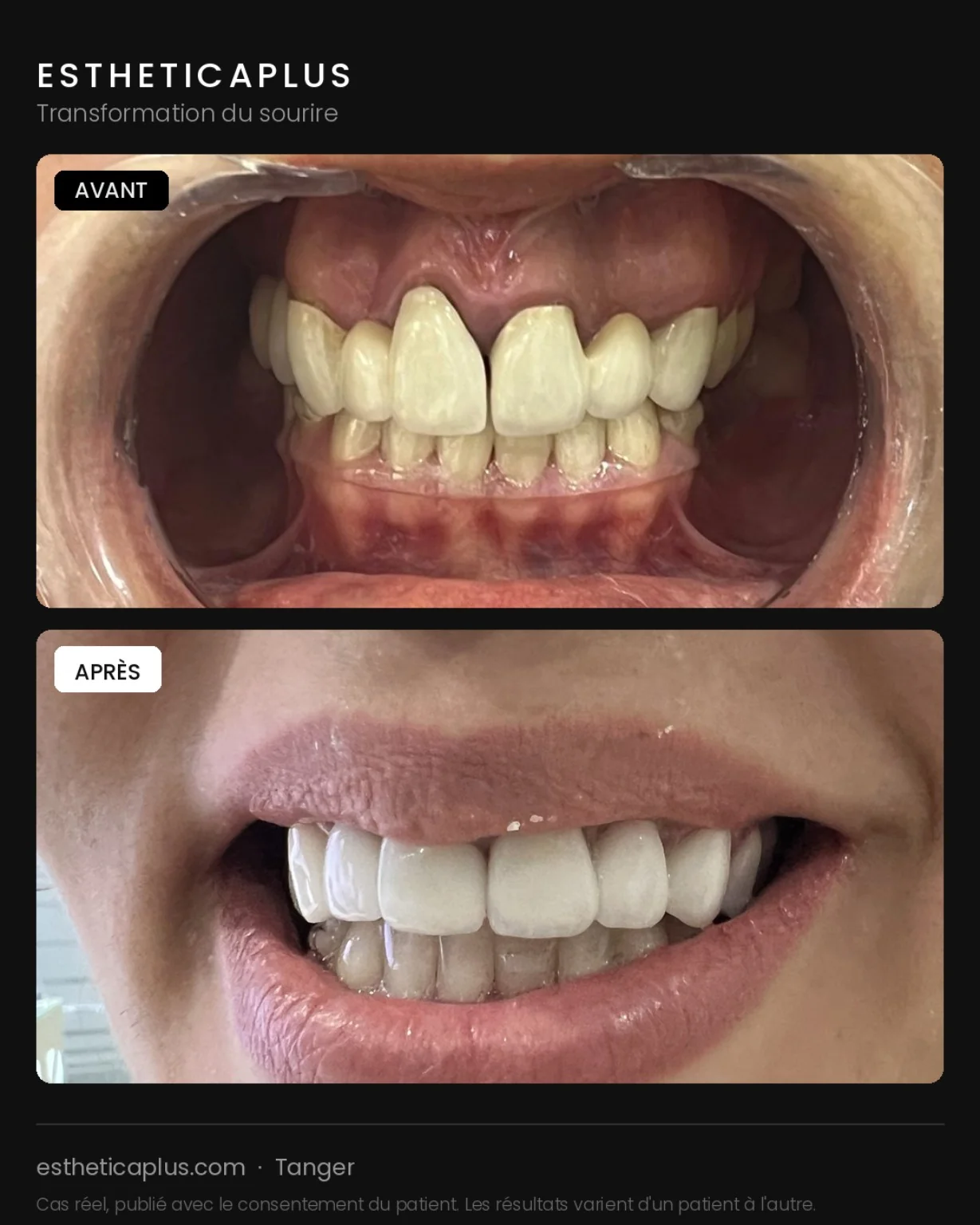 Transformation sourire avant après clinique dentaire Tanger