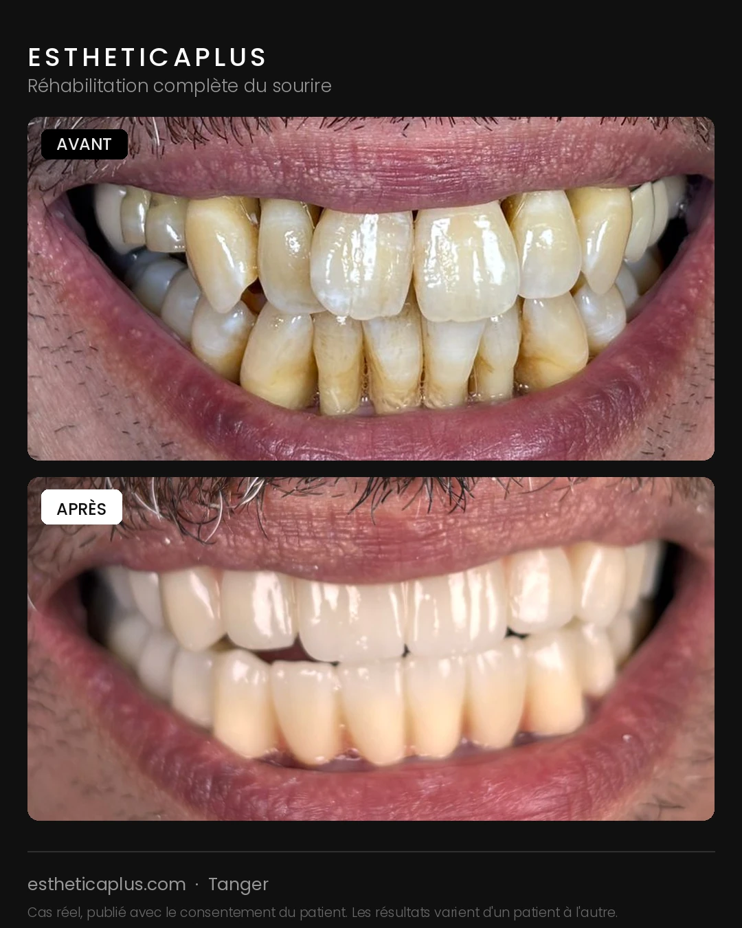 Réhabilitation complète du sourire avant après Tanger