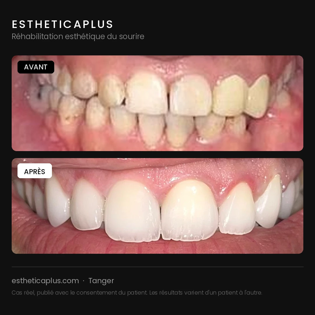 Réhabilitation esthétique sourire avant après EstheticaPlus Tanger