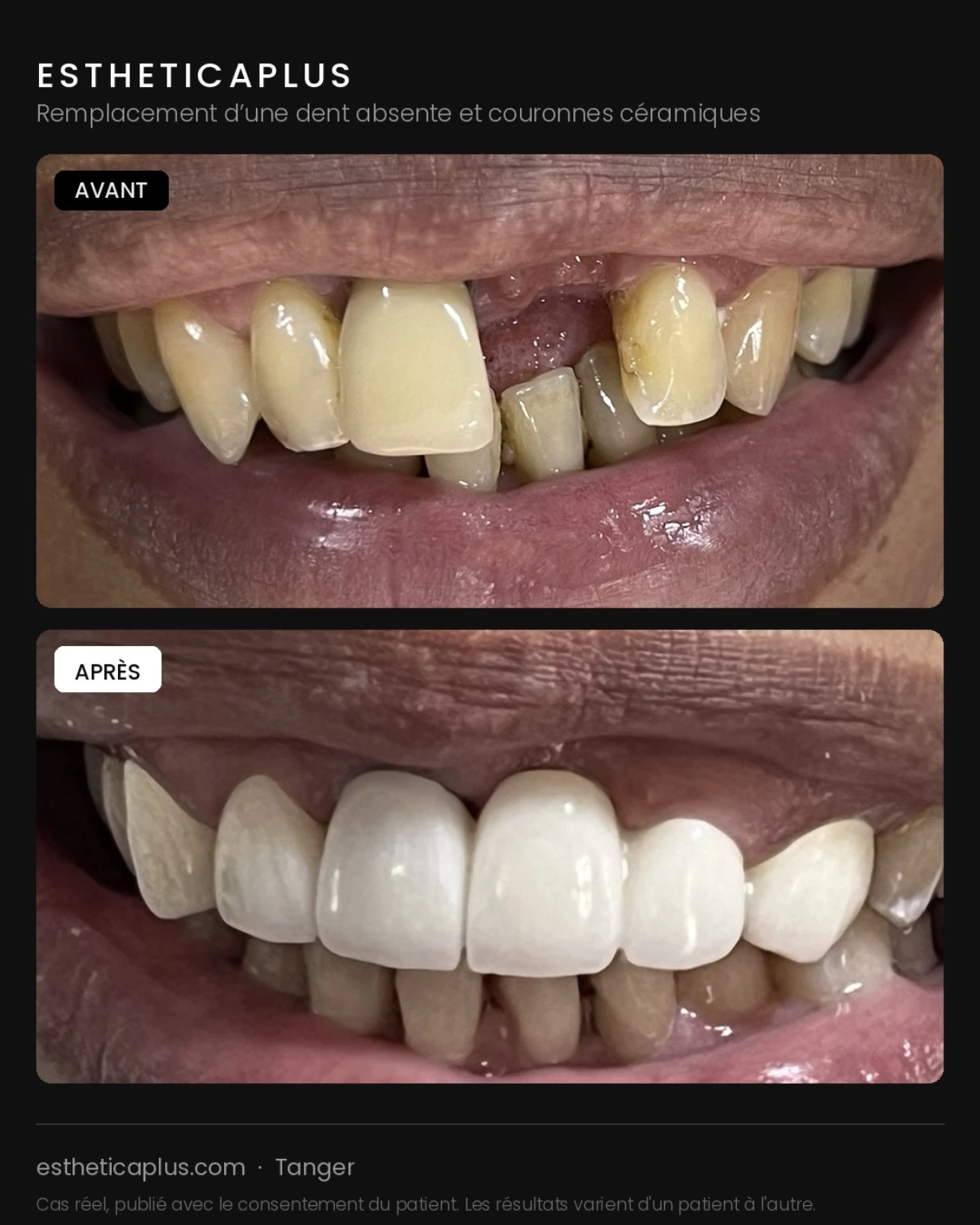 Remplacement dent absente couronne céramique Tanger