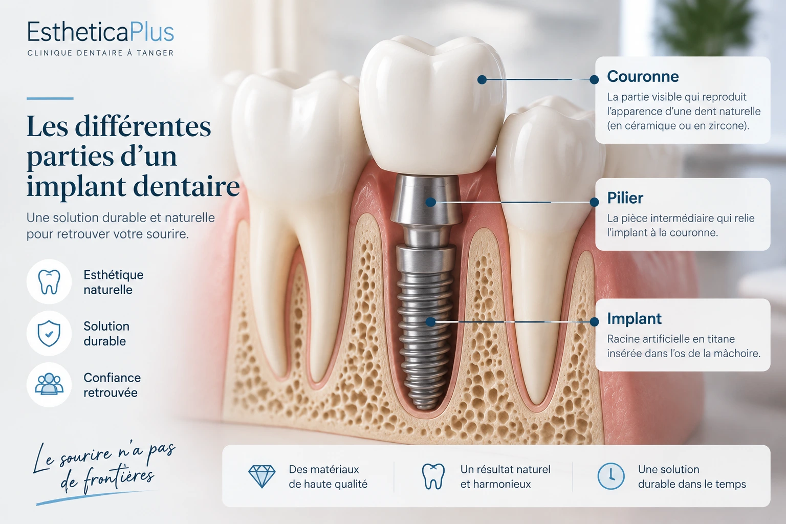 Schéma d'un implant dentaire avec implant en titane pilier et couronne
